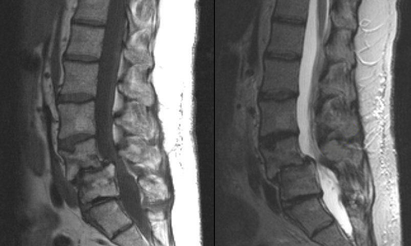 What spinal cord injury ? 