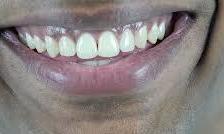 Barriers to oral health in impoverished areas of the world